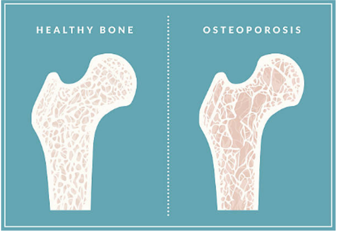 A diagram of a healthy bone next to a diagram of a bone with osteoporosis.